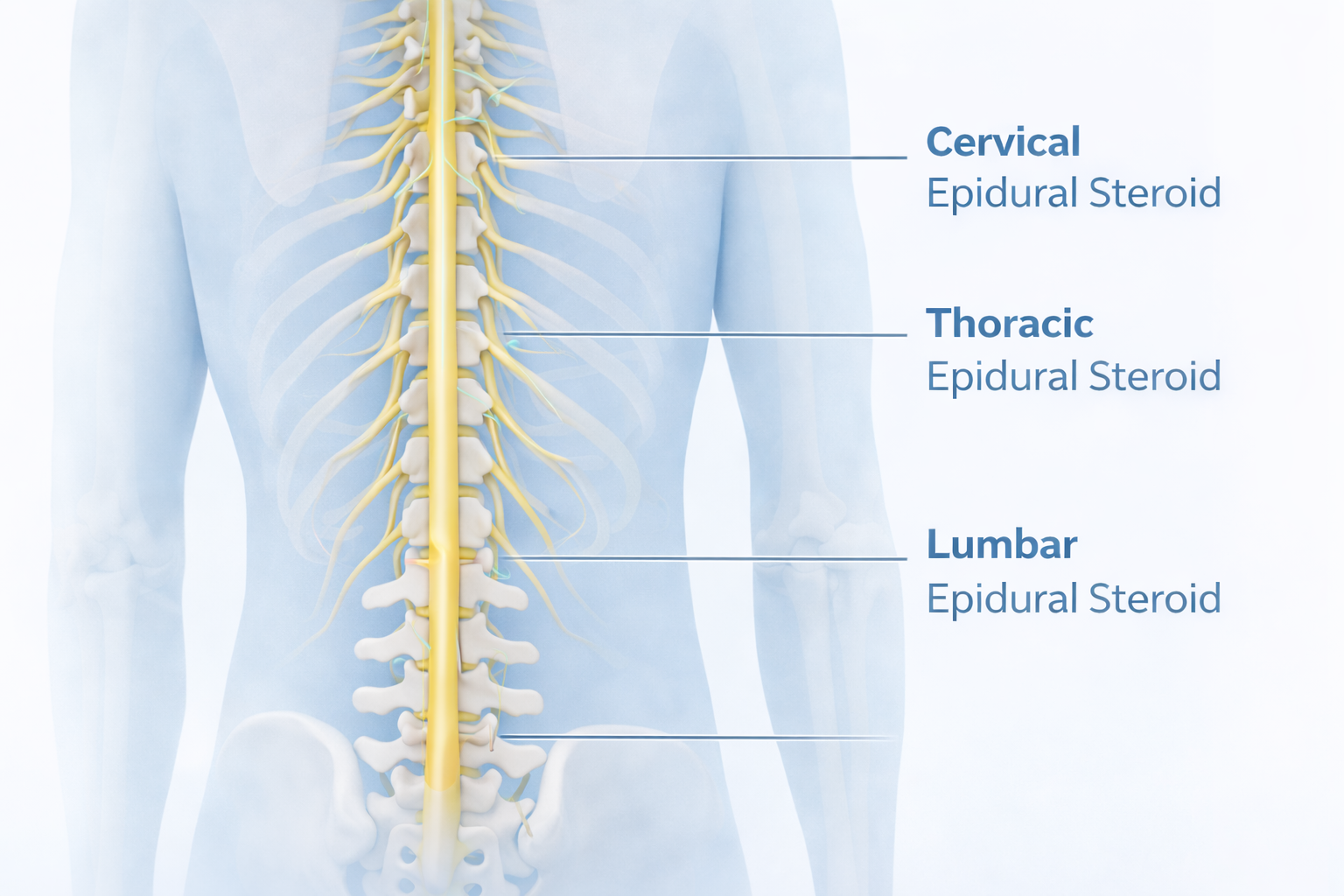 Lumbar, Thoracic & Cervical Epidural Steroid Injections